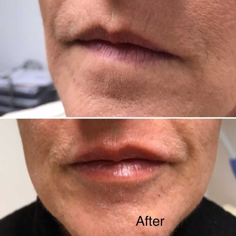 Lips & smokers lines filler